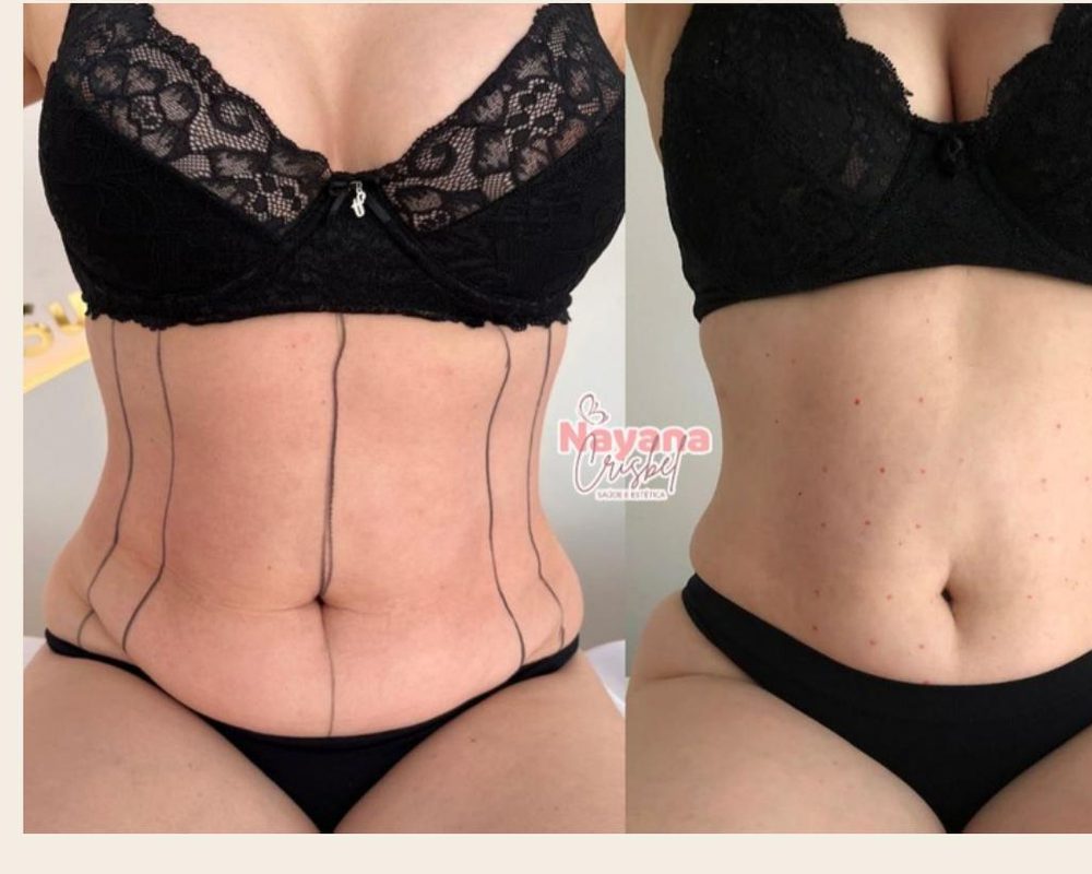 Antes e depois da Criomodelagem