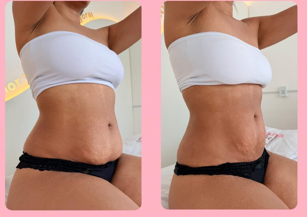 Antes e depois da Diástase 0