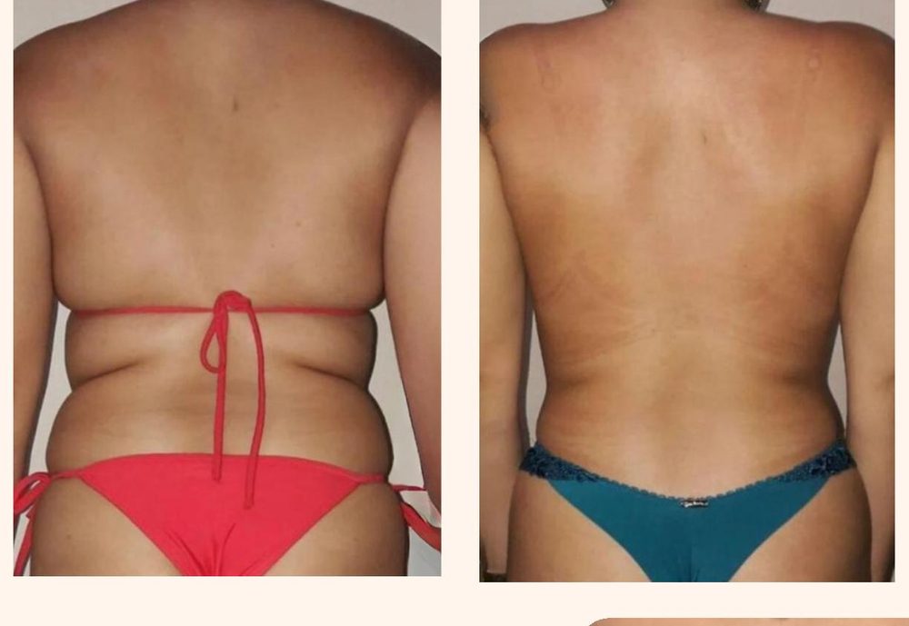 Antes e depois de injetáveis estéticos