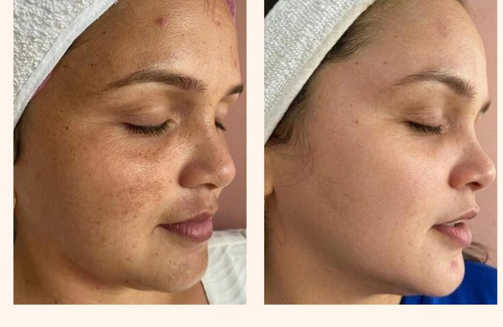 Antes e depois do Vulcan para melasma